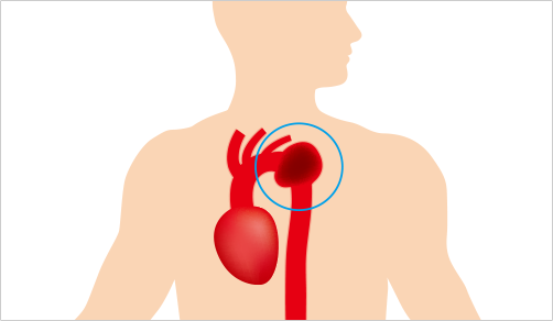 胸部大動脈瘤発症後