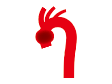 Aneurysm of ascending aortic aorta