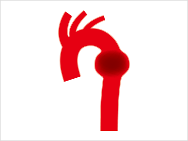 Aneurysm of descending aorta