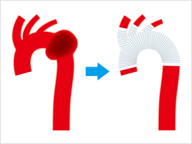 OPEN SURGICAL REPAIR(Blood vessel prosthesis implantation) 