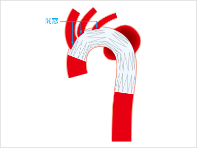 開窓型ステントグラフト 1