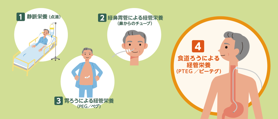 十分な栄養補給のために Ptegを用いた方法 Sbカワスミ株式会社